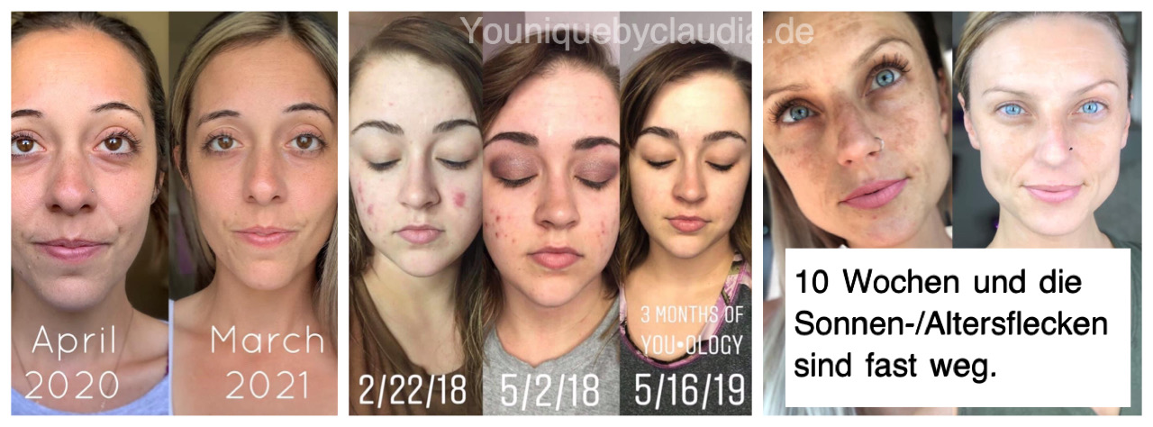 Younique Youology Altersflecken vorher nachher Ergebnis 