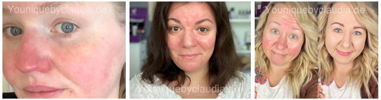 Younique Youology 1 Rosazea Rosacea Neurodermitis Schuppenflechte Couperose