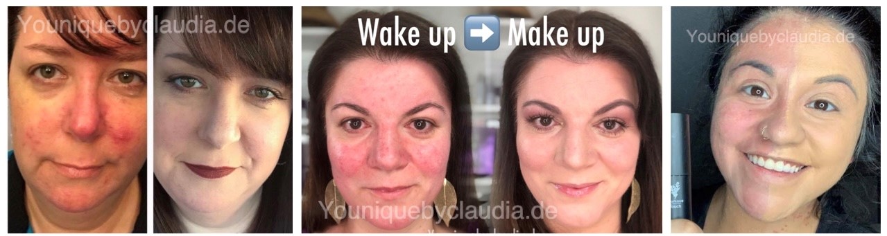Younique Youology 4 Rosazea Rosacea Neurodermitis Schuppenflechte Couperose