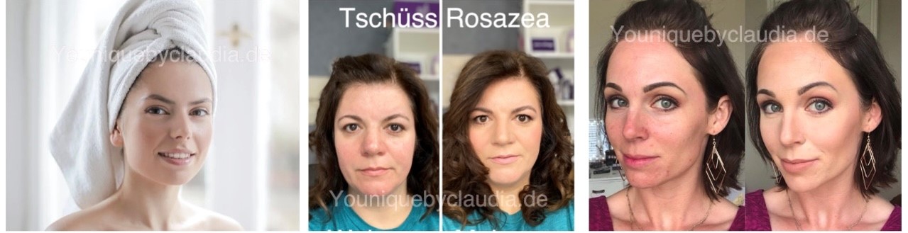 Younique Youology 5 Rosazea Rosacea Neurodermitis Schuppenflechte Couperose