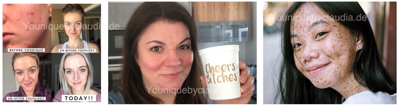 Younique Youology 6 Rosazea Rosacea Neurodermitis Schuppenflechte Couperose